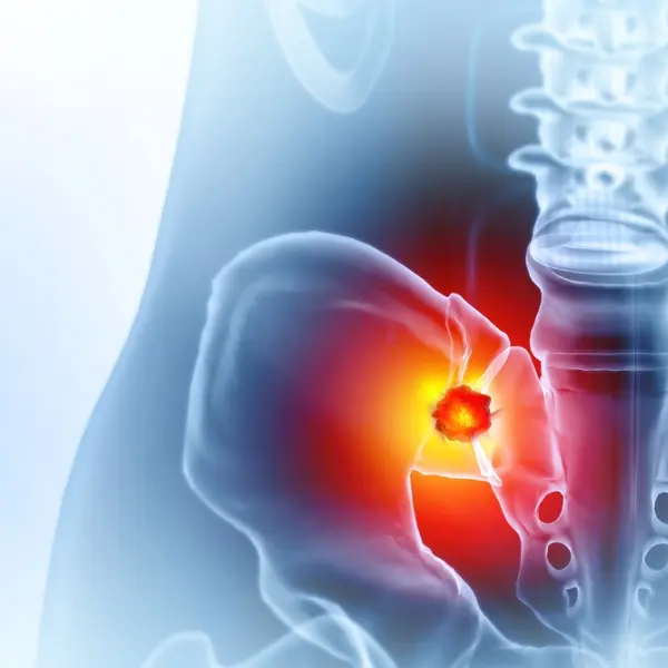 Acetabulum-Pelvic-Fracture-Fixation